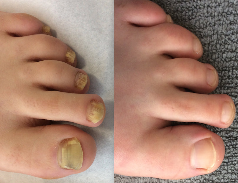 PodiCare™ Anti-Schimmel Spray | Schimmelvrije nagels in 7 dagen!