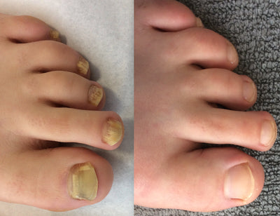 PodiCare™ Anti-Schimmel Spray | Schimmelvrije nagels in 7 dagen!