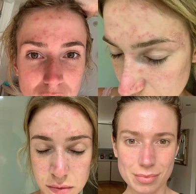 HerbalRefining™ Peel-Off Mask