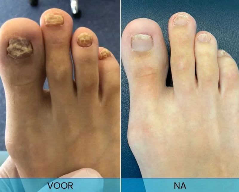 PodiCare™ Anti-Schimmel Spray | Schimmelvrije nagels in 7 dagen!