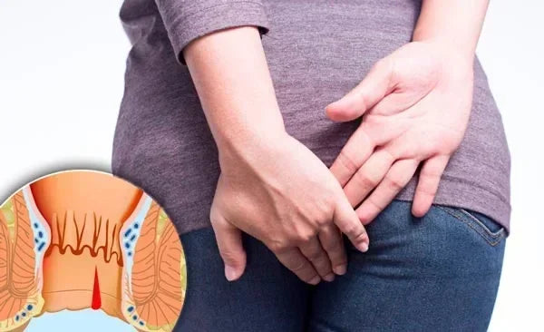 Direct verlost van aambeien en hun symptomen met HemoCare™!