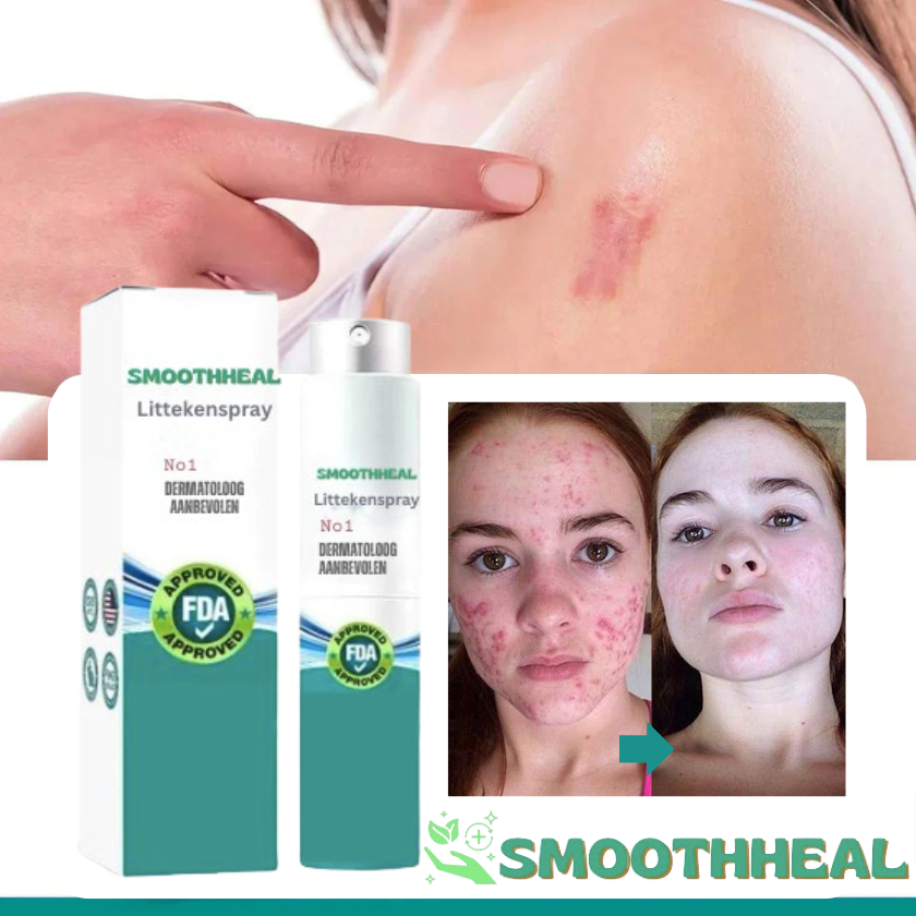 SmoothHeal™ Littekenspray | Verwijder ontsierende littekens, zichtbaar verminderd in 14 dagen!