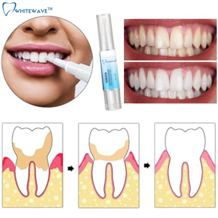 WhiteWave™ Tanden Bleken | Binnen 7 dagen prachtige, schone tanden!
