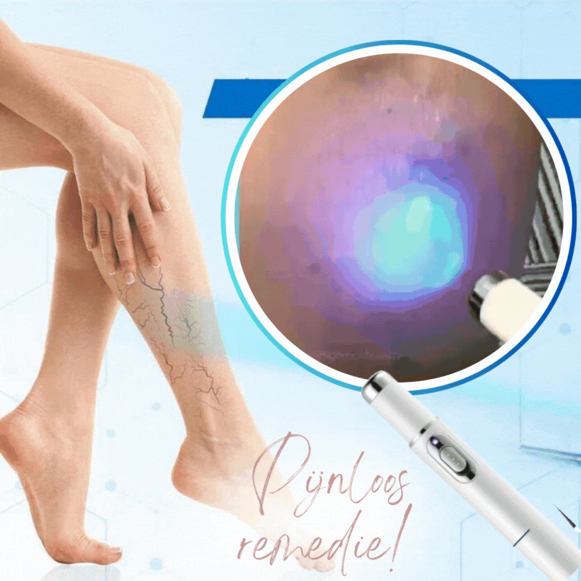 AderWeg™ BlauwLichtTherapie | Binnen 30 seconden af van je ongewenste en pijnlijke aders!